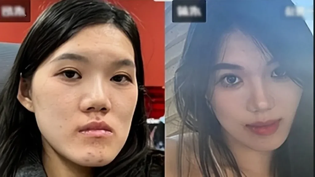 طلبت تعديلًا بسيطًا من طبيب التجميل.. فأصبحت قصتها حديث الملايين شابة تعاني من آثار خطأ طبي بعد خضوعها إلى جراحة تجميل الفك في مستشفى ووهان لطب الأسنان في الصين